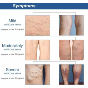 PARCHES VENAS VARICE X10